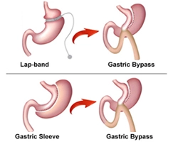 Bariatric Surgery Revisions