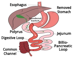 Duodenal Switch Surgery